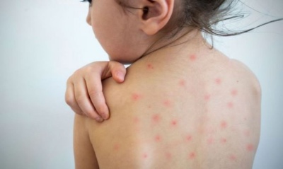 Salta: confirman un caso de sarampión en un nene