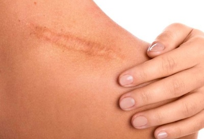 Investigadores demuestran que se puede imprimir piel viva sobre heridas