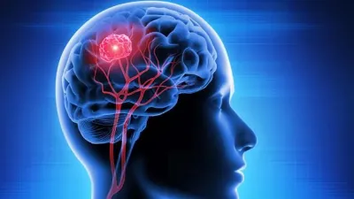Cáncer de cerebro: ¿Cuáles son los síntomas?