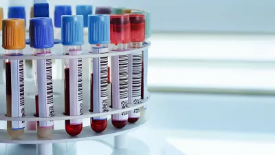 Nuevo análisis de sangre detecta accidentes cerebrovasculares peligrosos con alta precisión