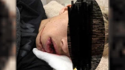 Brutal golpiza en Luján: le fracturaron la mandíbula a un pibe de 19 años