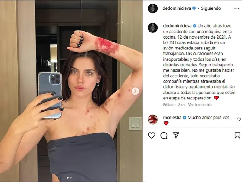 Eva De Dominici mostró fotos del terrible accidente que sufrió