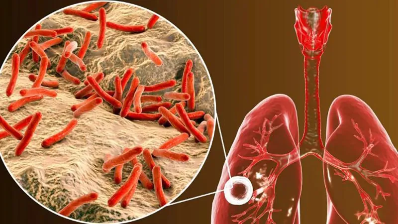 Día Mundial de la Tuberculosis: ¿qué es y cuáles son los sintomas?